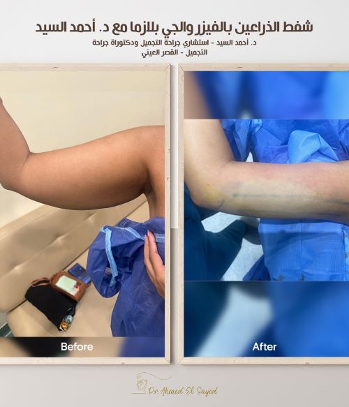 شفط الذراعين بالفيزر